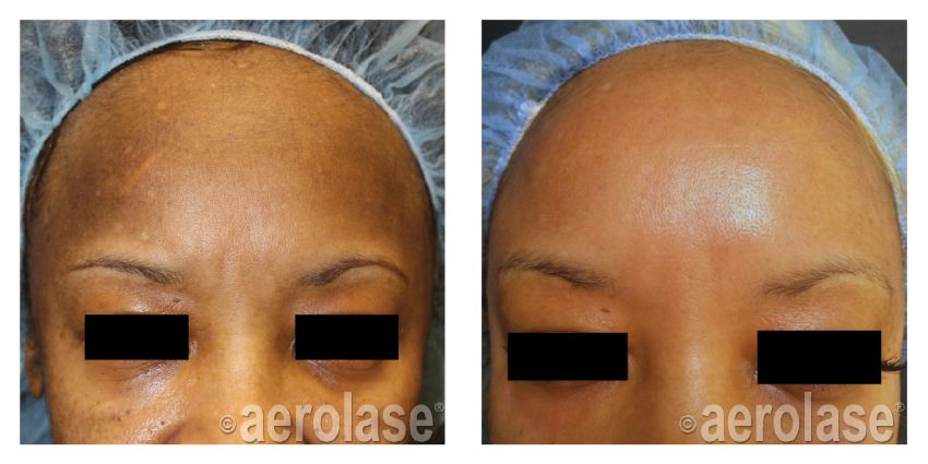 After 1 Treatment combined with Glycolic Peel