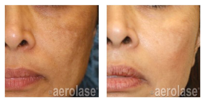 After 1 Treatment combined with Hydroquinone