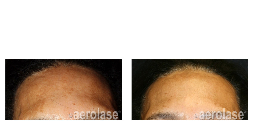 After 1 Treatment combined with TCA Peel