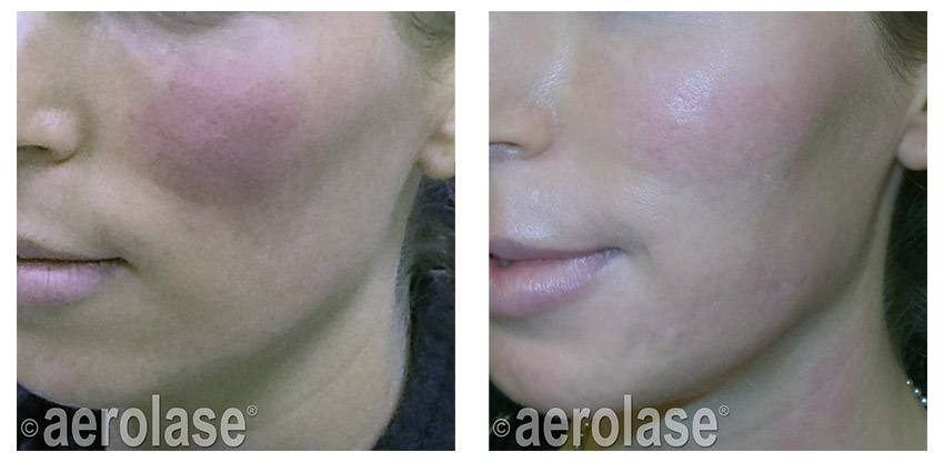 After 1 Treatment